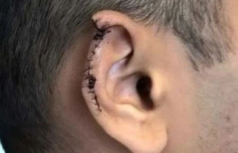 Jovem perde parte da orelha durante briga em Pão de Açúcar